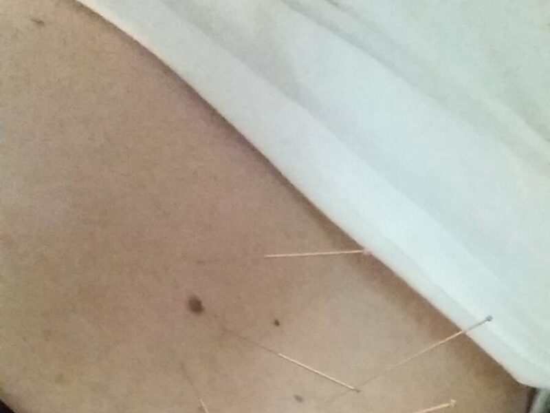 Close-up of thin acupuncture needles placed along a patient's back during treatment